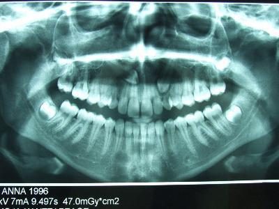 xray